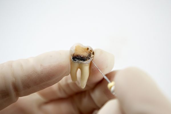 Dentista mostrando tratamiento de endodoncia en Dos Hermanas