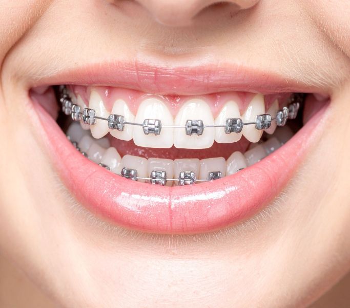 Tratamiento de ortodoncia con brackets en la Clínica Dental Dra. Ana Pérez Redaño en Dos Hermanas