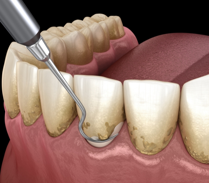 Tratamiento de periodoncia en la Clínica Dental Dra. Ana Pérez Redaño en Dos Hermanas