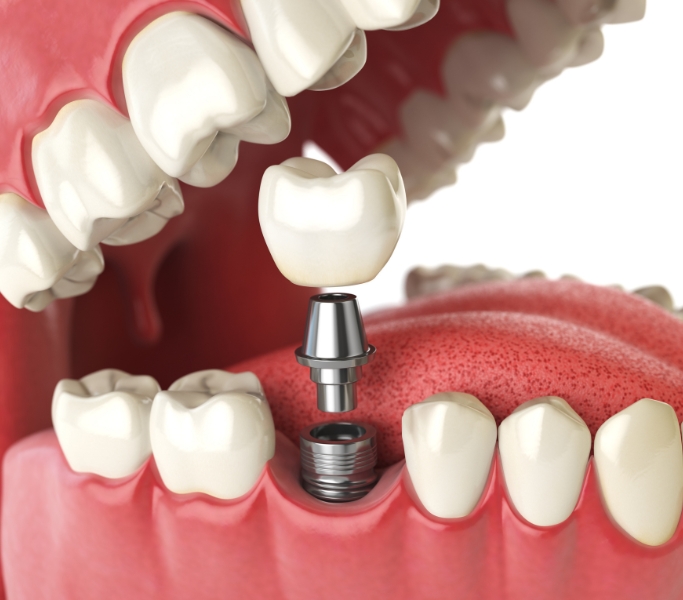 Prótesis dental para reemplazar piezas en la Clínica Dental Dra. Ana Pérez Redaño en Dos Hermanas