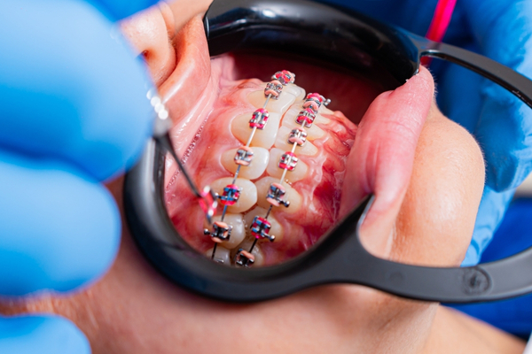 Especialista en ortodoncia ajustando brackets en clínica dental de Dos Hermanas.