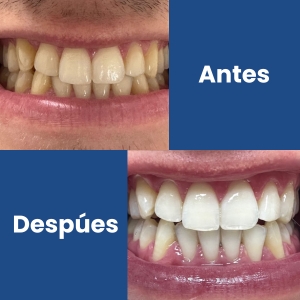 Blanqueamiento Dental