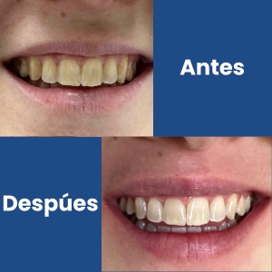 Blanqueamiento Dental II (1)