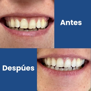 Blanqueamiento Dental III (1)