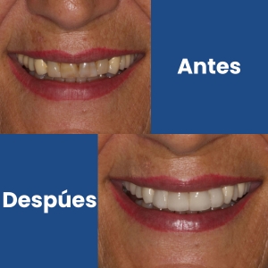 Carillas dentales