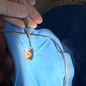 Endodoncia inferior