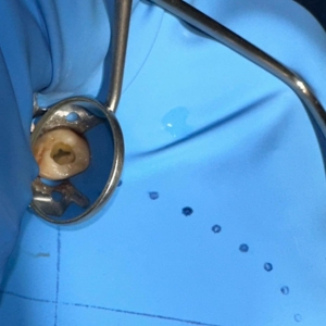 Endodoncia superior