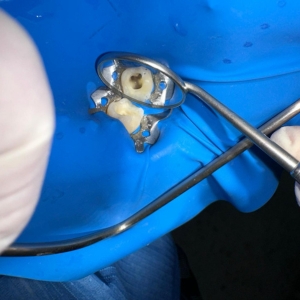 Endodoncia