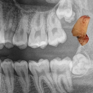 Inclusiones dentales Izquierda