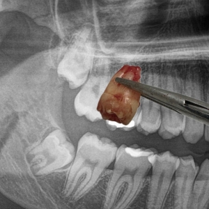 Inclusiones dentales derecha