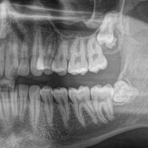 Inclusiones dentales