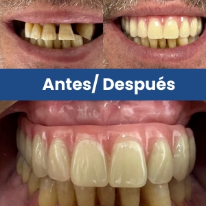 Prótesis dental antes vs después (1)
