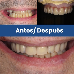 Prótesis dental antes vs después Superior (1)