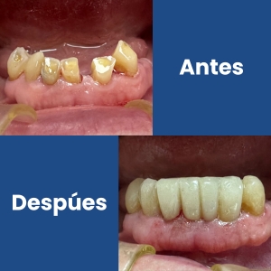 Prótesis dental antes vs después inferior (1)