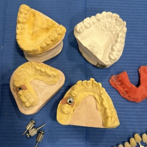 Prótesis dental sobre implantes