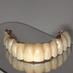 Protesis sobre implantes II