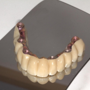 Protesis sobre implantes